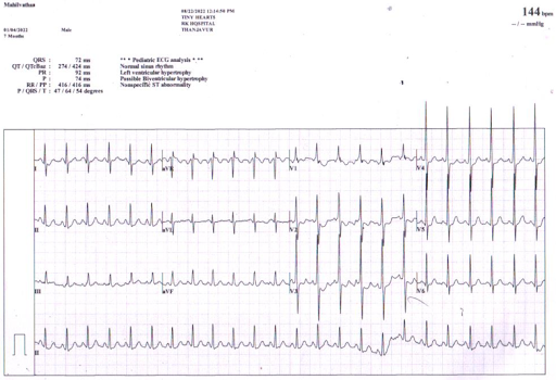 Ventricular-Hypertrophy-1