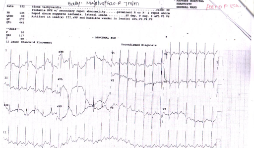 Ventricular-Hypertrophy-2