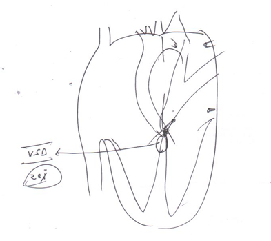 Ventricular-Hypertrophy-5