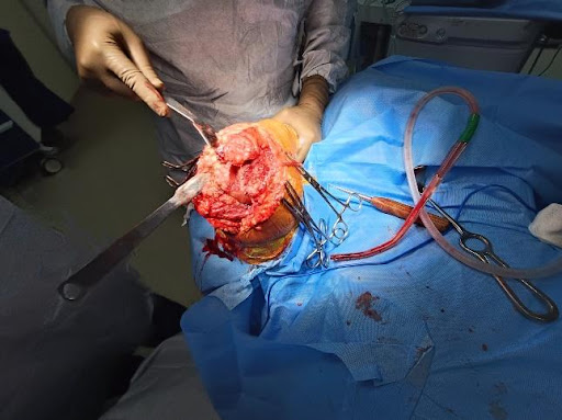 Elbow-arthroplasty-2