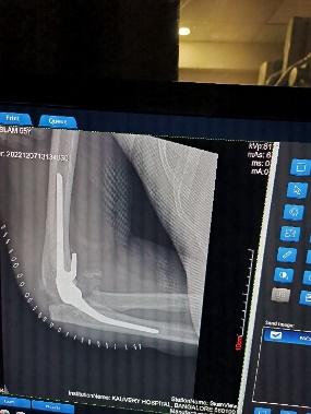 Elbow-arthroplasty-4