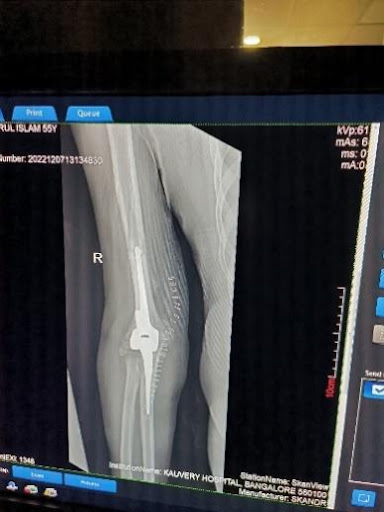 Elbow-arthroplasty-5
