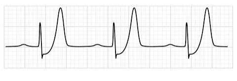 STEMI5
