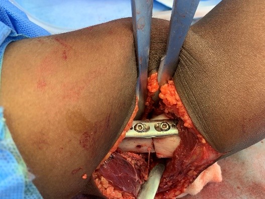 Gunstock deformity
