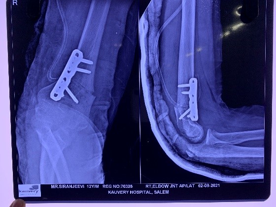 Gunstock deformity