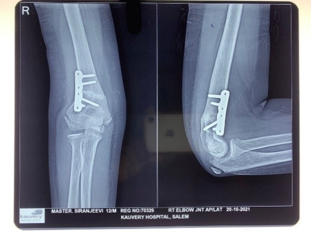 Gunstock deformity