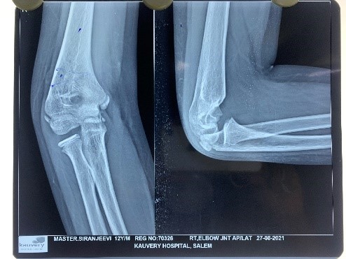Gunstock deformity