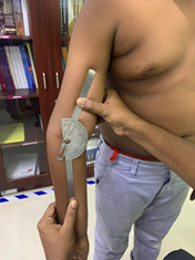 Gunstock deformity