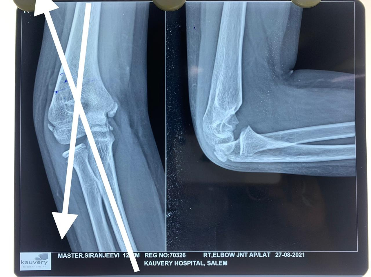 Gunstock deformity