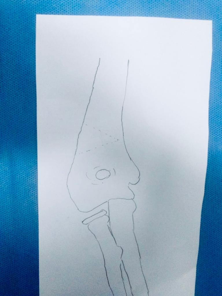 Gunstock deformity