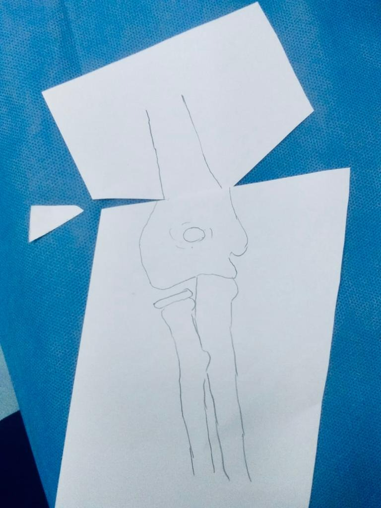 Gunstock deformity