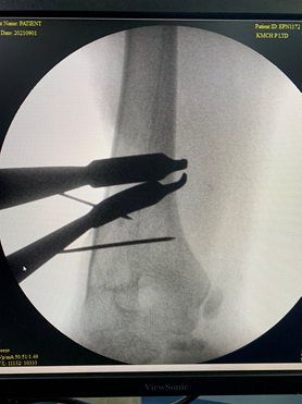 Gunstock deformity
