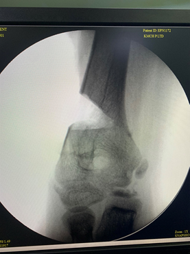 Gunstock deformity