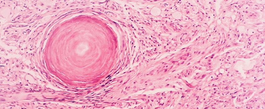 Treatment for Meningioma in Chennai,India