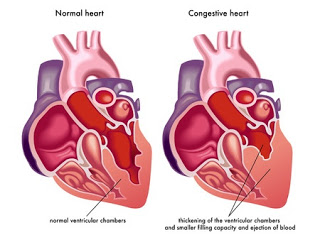 Treatment for Congestive Heart Failurein Chennai, Trichy, Hosur, Salem,Tirunelveli|Kauvery Hospital