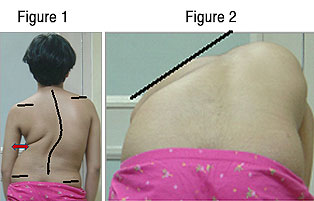 Kauvery Hospital Patient Newsletters Scoliosis Or Spine - 
