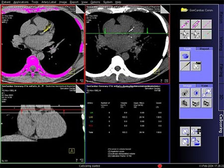 CT Calcium score