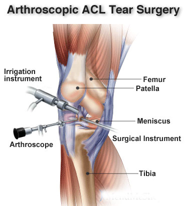 Knee Ligament Injury, Cause and Recovery