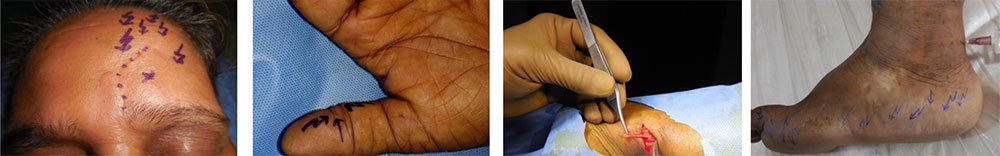 Neuroplastic Surgery in Chennai, Trichy, Salem,Tirunelveli, India