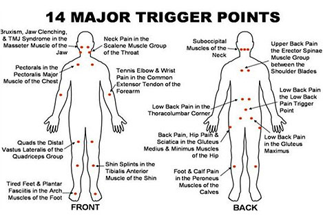 trigger-points