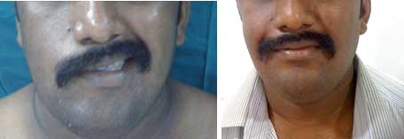 Plastic Surgery Face