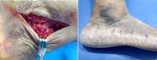 Plastic Surgery Feet