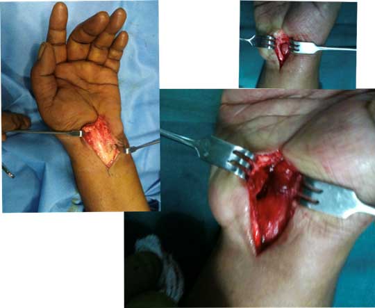 Plastic Surgery Hand