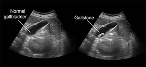 diagnose-gallstones