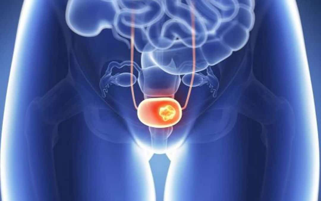 Neo Bladder reconstruction for Bladder Cancer (No Stoma Surgery)