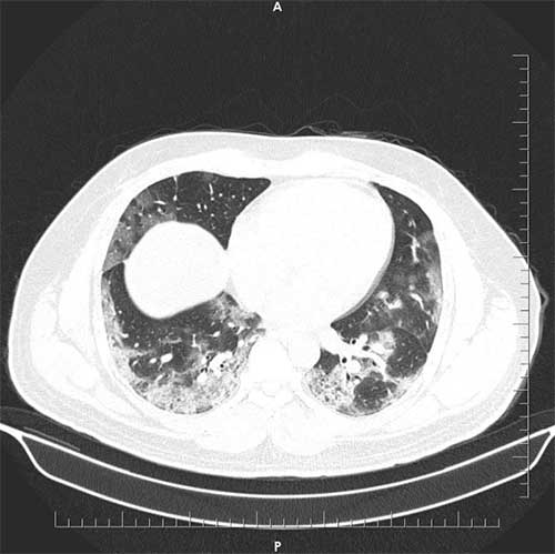 ct-chest-1