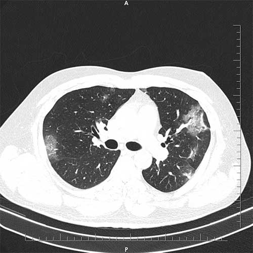 ct-chest-2