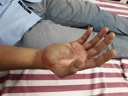 2nd degree deep burn over right palm