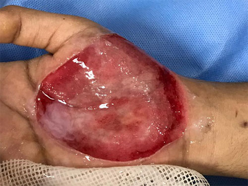 After incision drainage & deroofing the blister