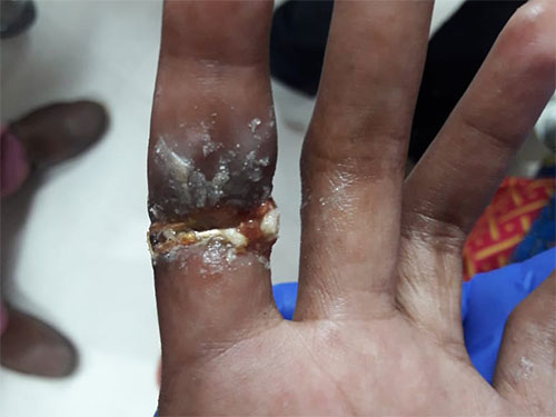 Ring causing ulceration & infection due to induration