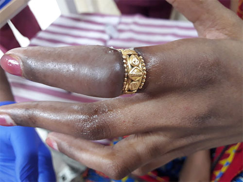 Ring constriction causing bluish discolouration over distal aspect of finger