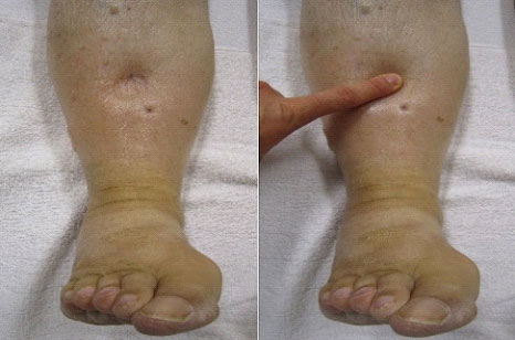 Swelling of the Legs