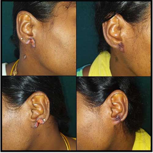 Earlobe Repair Treatment & Surgery in Bangalore (2023)