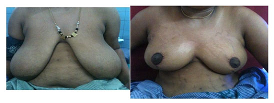 KKK Syndrome – Kai Kaal Kodaichal Syndrome – கை கால் கொடைச்சல் Syndrome