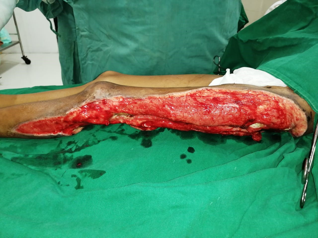 Successful discharge of a four year old baby with life threatening gas gangrene and compartment syndrome