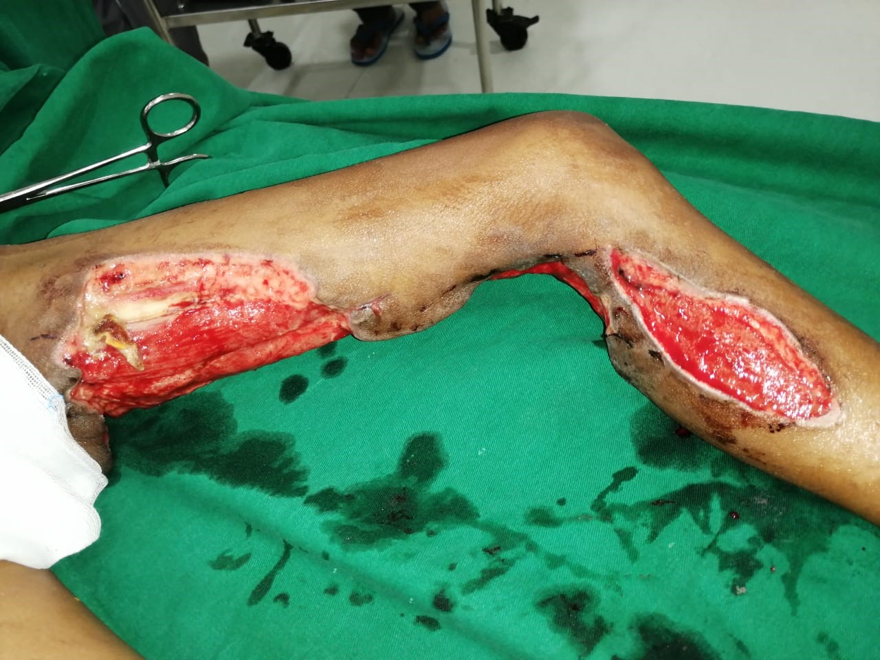 Successful discharge of a four year old baby with life threatening gas gangrene and compartment syndrome