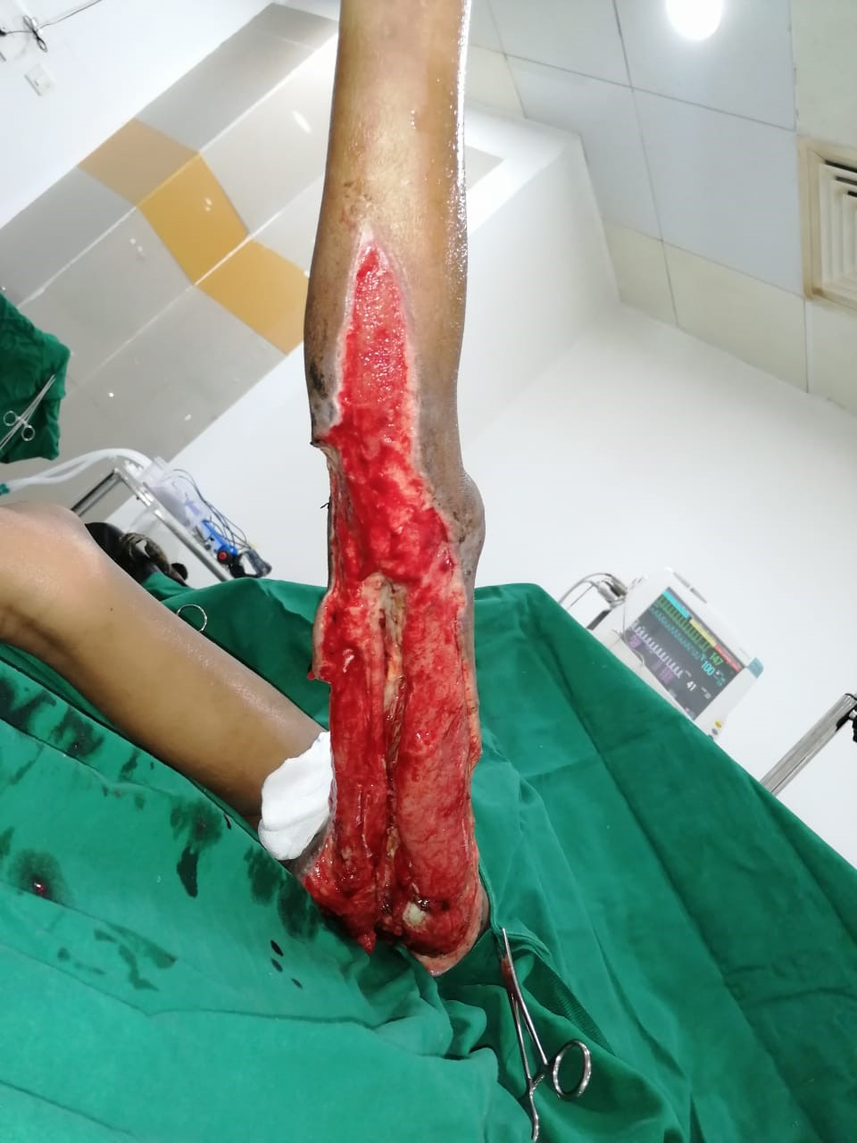 Successful discharge of a four year old baby with life threatening gas gangrene and compartment syndrome