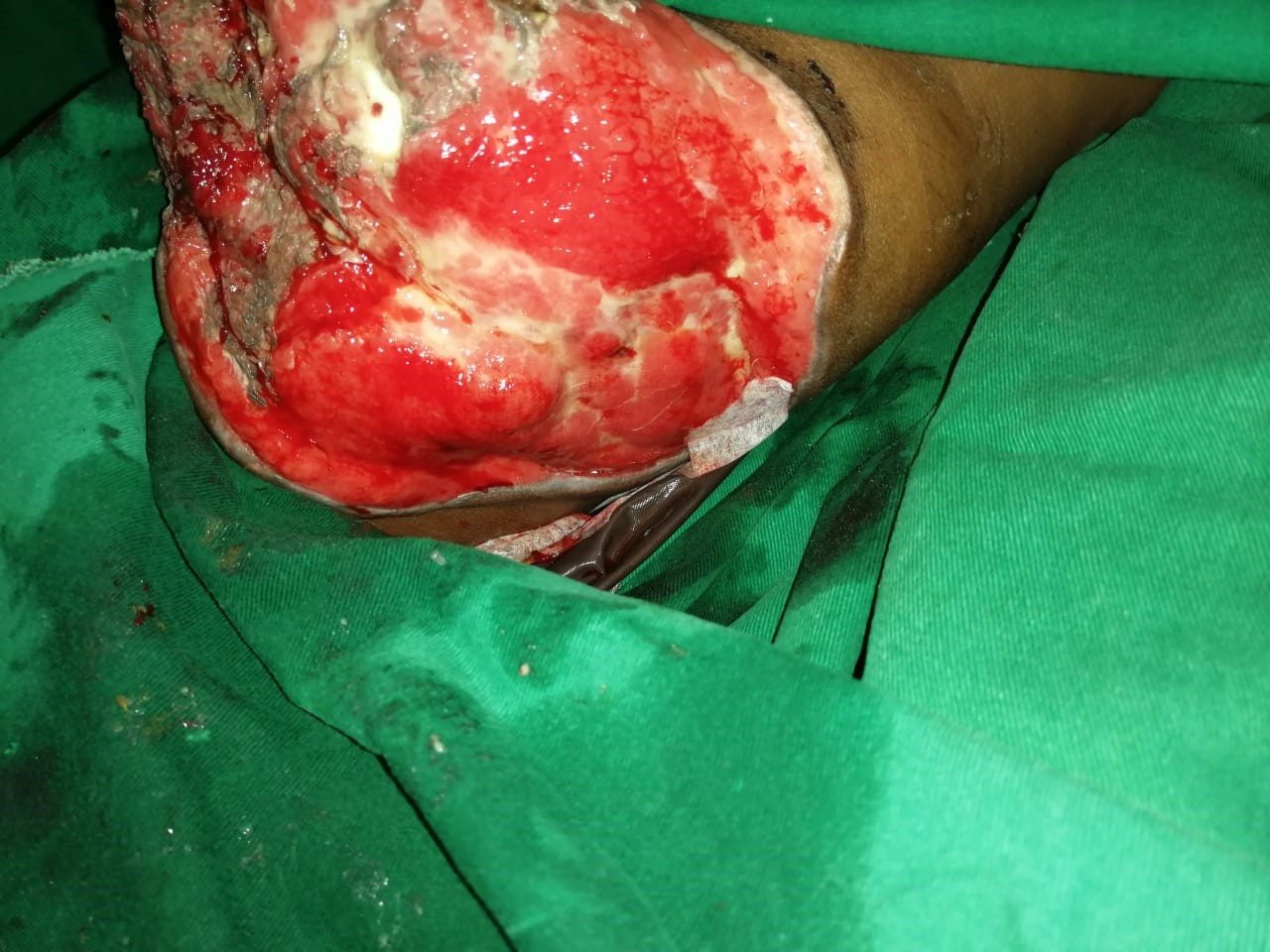 Successful discharge of a four year old baby with life threatening gas gangrene and compartment syndrome