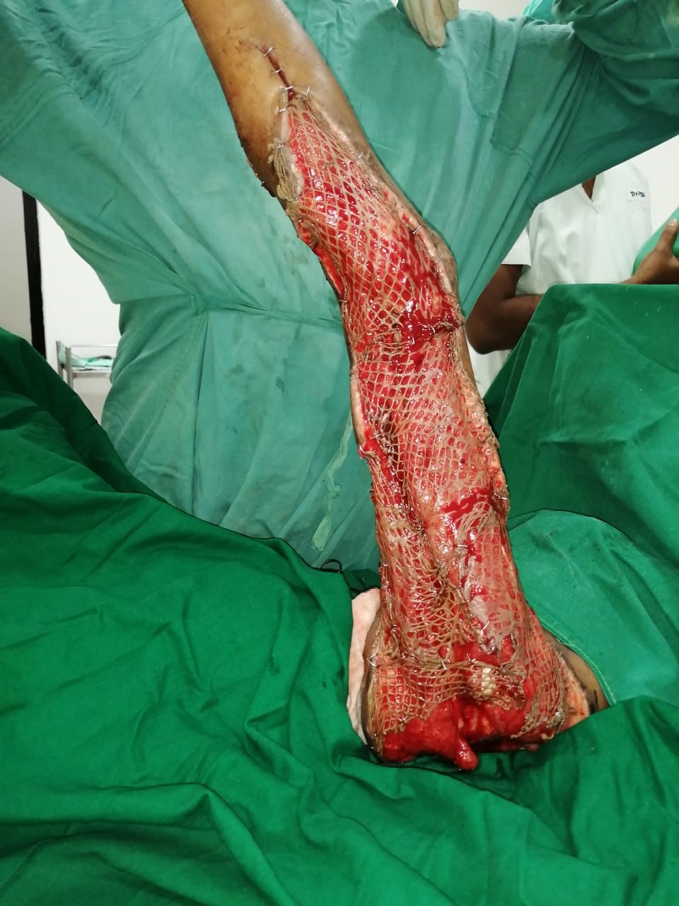 Successful discharge of a four year old baby with life threatening gas gangrene and compartment syndrome