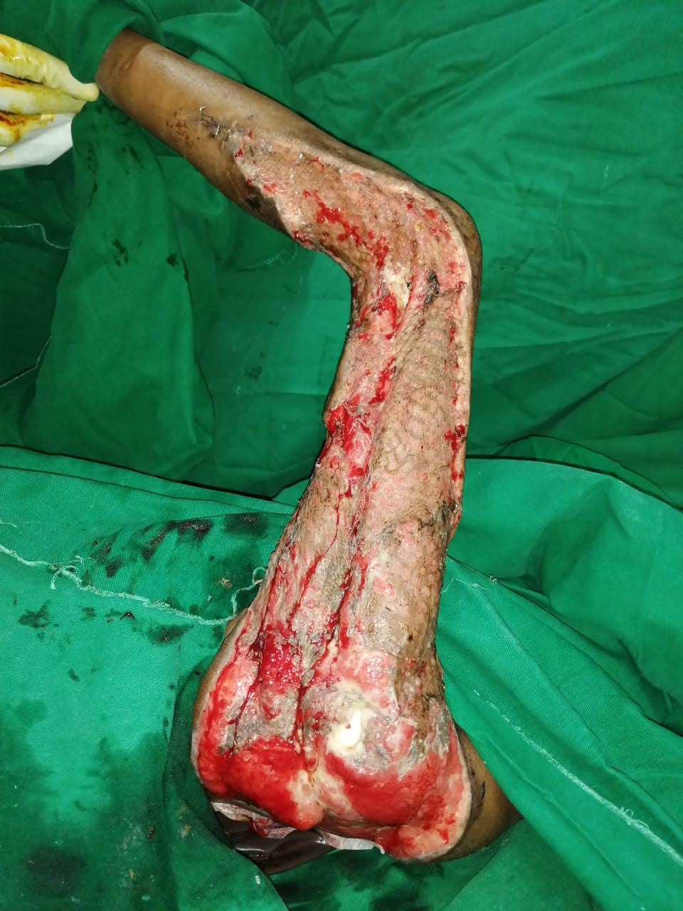 Successful discharge of a four year old baby with life threatening gas gangrene and compartment syndrome