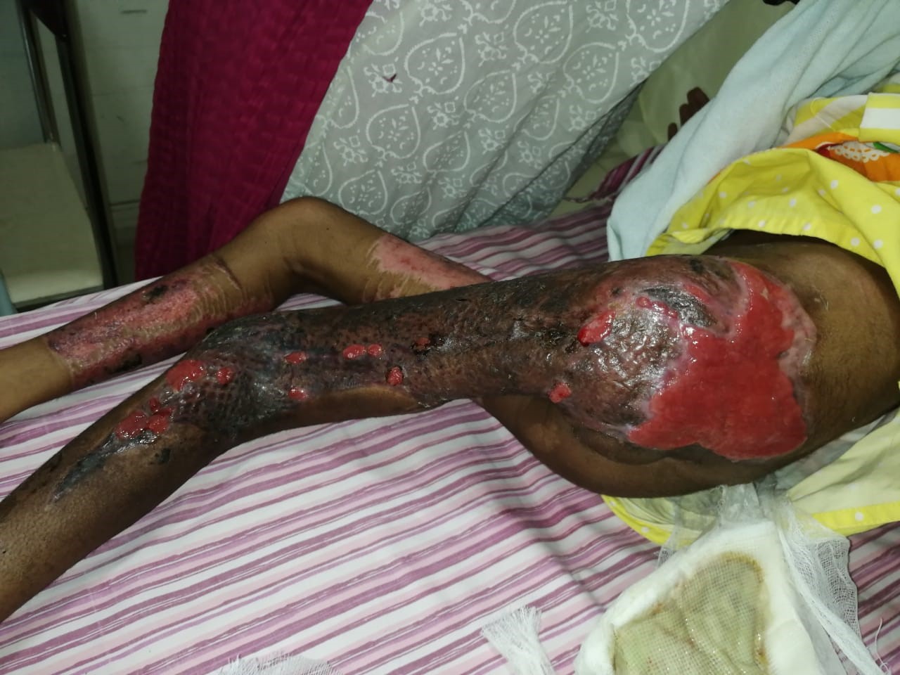 Successful discharge of a four year old baby with life threatening gas gangrene and compartment syndrome