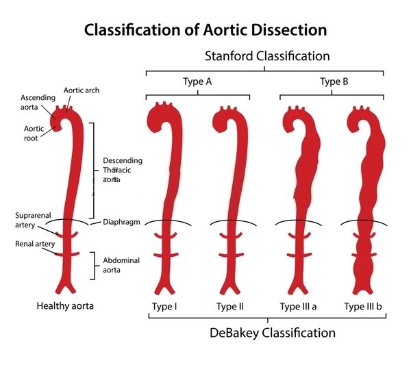 Classification of Aortic Dissection