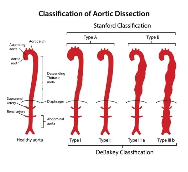 aortic-dissection-1