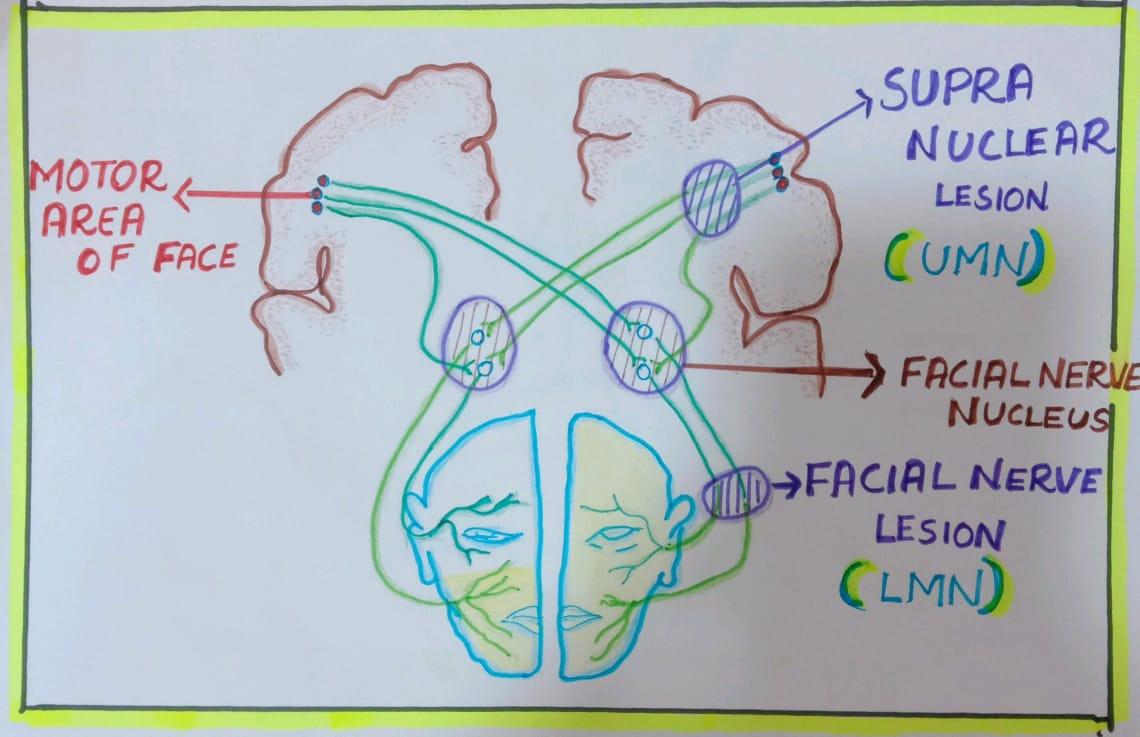 Motor points of face for electrical stimulation of bell's palsy