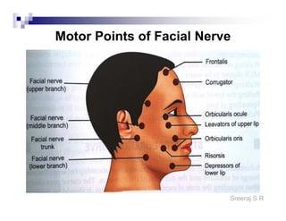 Motor points of face for electrical stimulation of bell's palsy