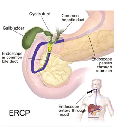 Complex ERCP during the COVID-19 Pandemic.